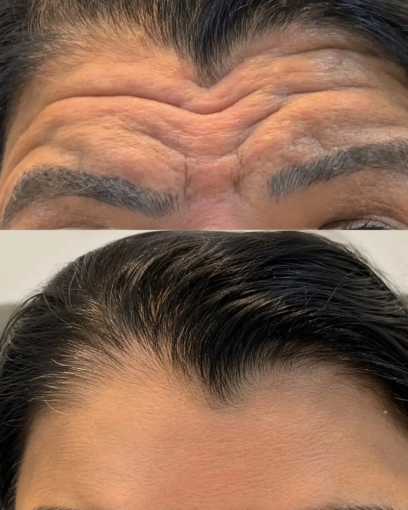 Botox Injections
