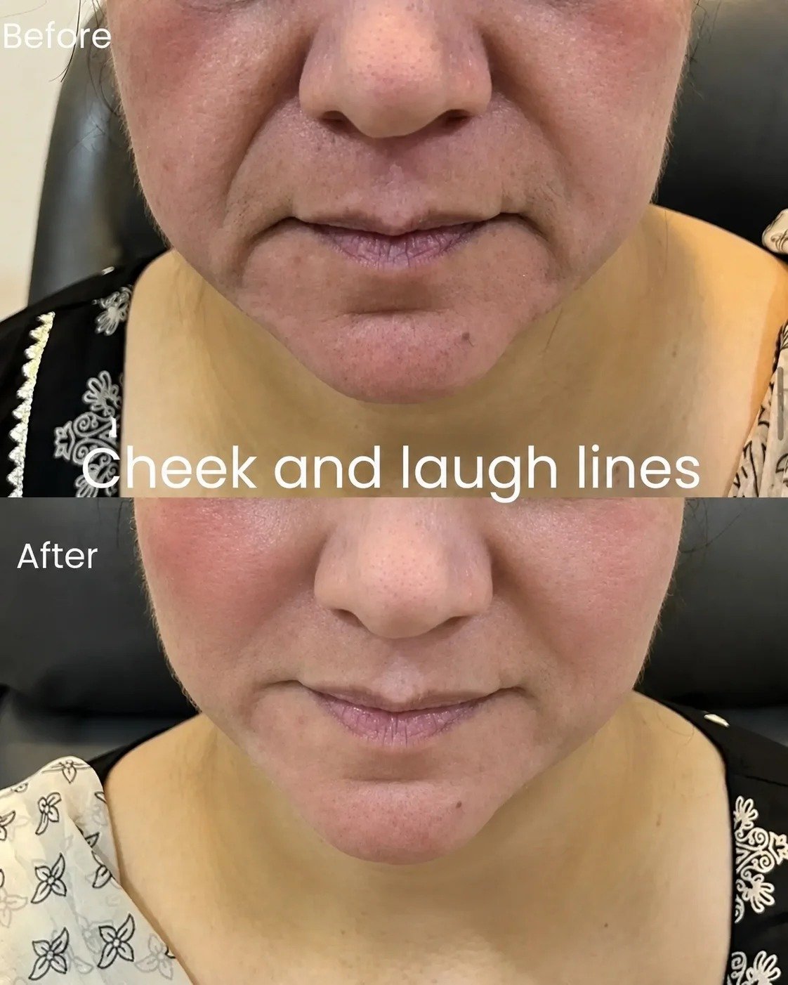 Cheek and Laugh Lines