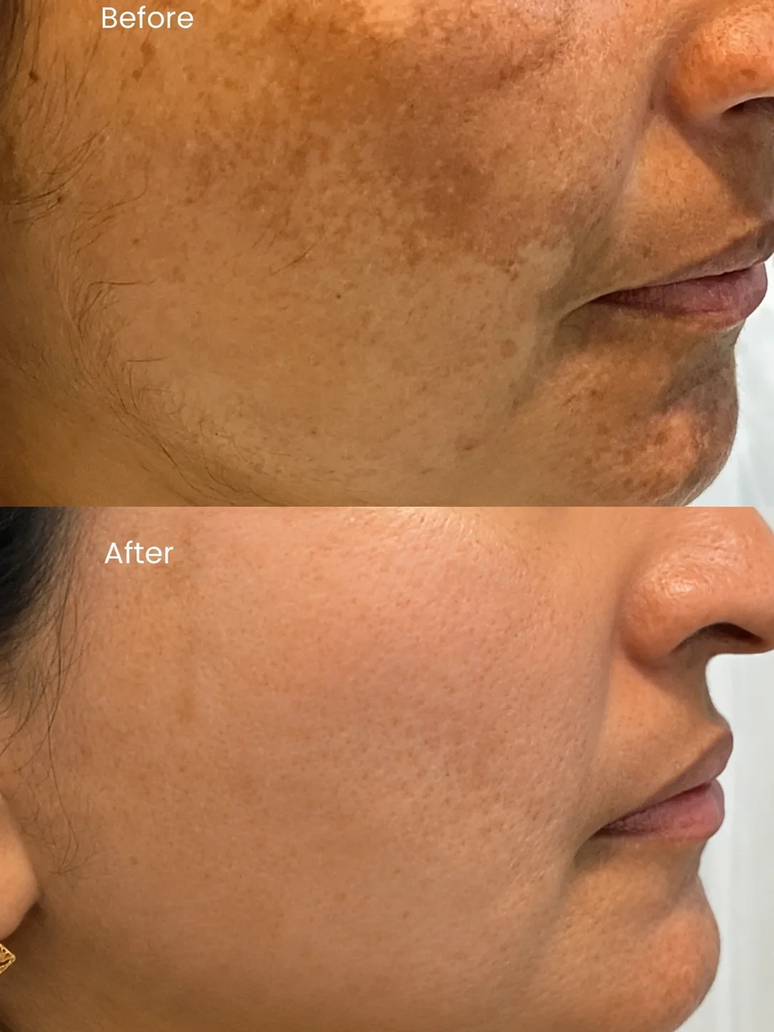 Customized Melasma Treatment