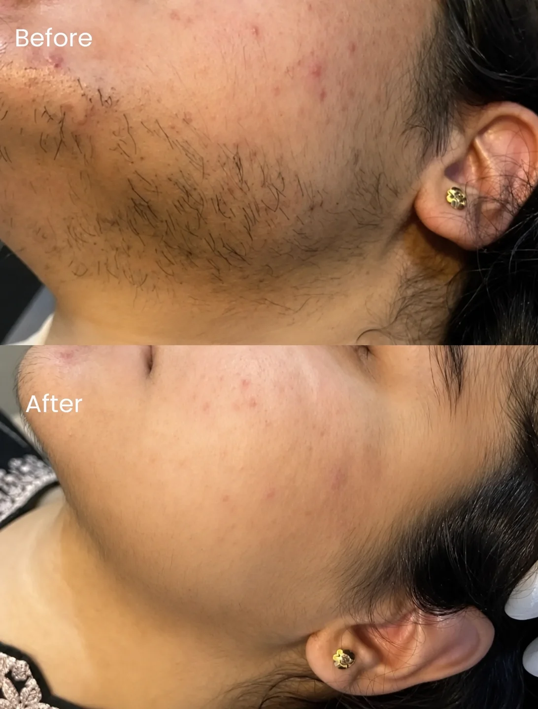 Laser Treatment