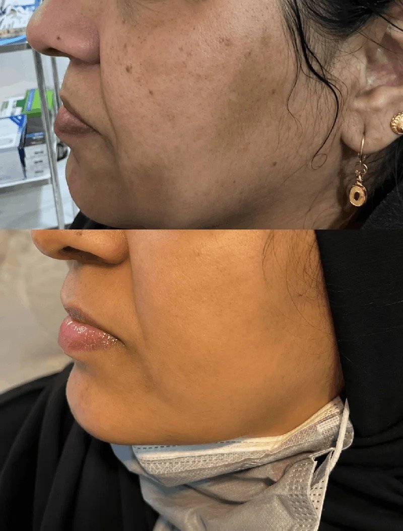 Melasma Treatment