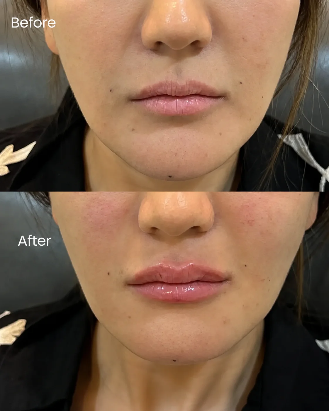 lip Fillers